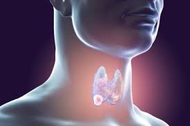 Cuando el cáncer se origina en la glándula tiroides, se denomina cáncer de tiroides. Sintomas En Las Mujeres Que Alertan Un Posible Cancer De Tiroides Mejor Con Salud