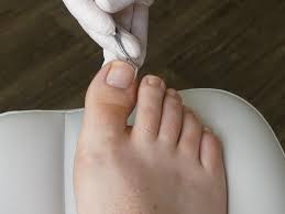 what is permanent ingrown toenail removal