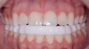 Dental splinting, used to treat loose teeth, involves joining teeth together. Occlusal Splint Therapy Basics Schur Orthodontics