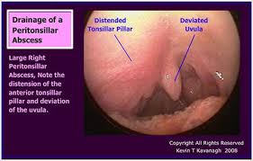 peritonsillar abscess quinsy surgical