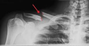 There are a whole host of conservative and surgical options that can help heal a broken clavicle