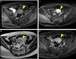 metastatic myxoid liposarcoma