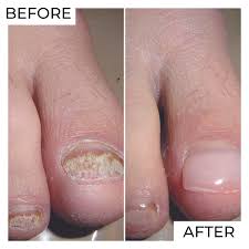 keryflex fingernail and toenail