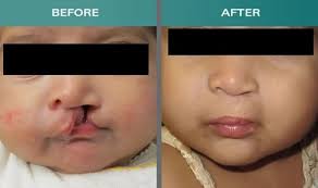 cleft lip and palate treatment at best