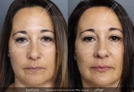 It can take as little as 30 minutes if using hyaluronic acids and patients can return home following this treatment. How Melbourne Residents Can Get Rid Of Bags And Dark Circles Under The Eyes With Dermal Fillers Facelove
