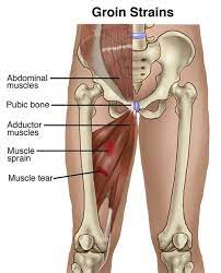 Can you show me pictures relating to the area of hernia groin? Pin On Symptoms And Conditions