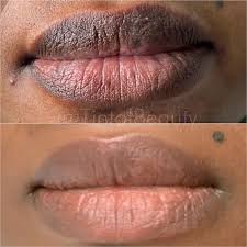 affordable lip neutralization in