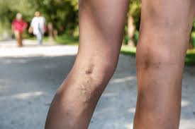 This prevents the blood from leaking out and protects the. What Is Deep Vein Thrombosis What Are The Signs And Symptoms Of Dvt And What S The Treatment
