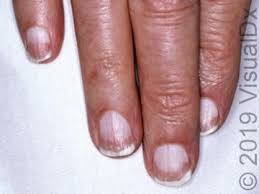 diagnosis of half and half nails
