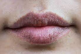 dark lips treatment skin plus delhi