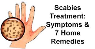 scabies treatment symptoms 7 home
