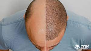 shock loss after hair transplantation