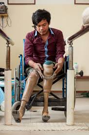 prosthetics care in cambodia