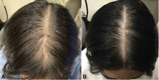 Spironolactone for treatment of female pattern hair loss - Journal of the  American Academy of Dermatology