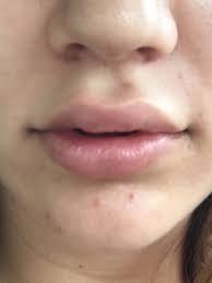 uneven lip after lip filler photos