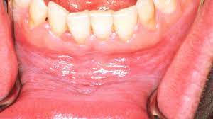 white gums causes treatmentore