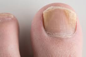 fungal nail infection nhs