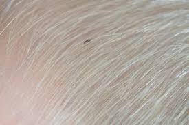 These head lice pictures can help you. Head Lice And Nits Nhs