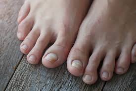 6 causes of yellow toenails and