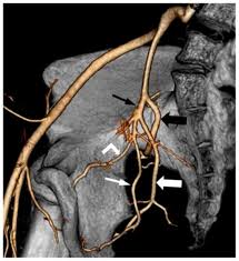 Female internal iliac artery branches. Angiographic Evaluation Of The Internal Iliac Artery Branch In Pelvic Tumour Patients Diagnostic Performance Of Multislice Computed Tomography Angiography