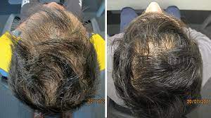 case study severe hair loss reversed
