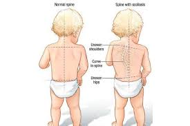 scoliosis in kids rapid physiocare