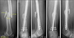 nonunion for fem shaft fracture