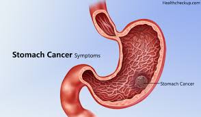 Stomach cancer is usually asymptomatic early on, or causes vague symptoms like bloating, indigestion, and a feeling of fullness in the upper abdomen. Early Signs Symptoms Of Stomach Cancer Diagnosis Of Stomach Cancer