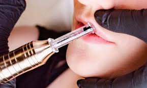 Lip enhancement procedure uses the hyaluron pen to deliver hyaluronic acid into the lips, restoring some of its plump. Hyaluron Pen Lip Fillers Beauty F X