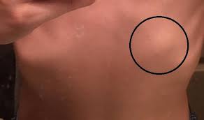 There are 12 ribs on each side (left and right) and a clavicle (collarbone) on the left and right as well. Hard Bony Round Lump On Right Of Rib Cage Upper Abdomen The Lump Goes In When I Exhale And Comes Back Out When I Inhale It Doesn T Hurt When I Touch It