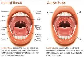 canker sores sabka dentist top