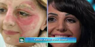 tattoo artist conceals burn scars