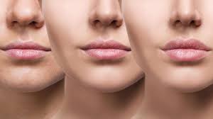 lips augmentation in delhi lip fillers