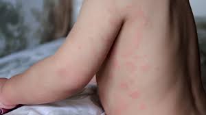 hives causes risks prevention and