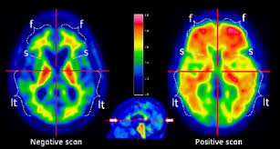 Image result for oraganicgreendoctor amyvid pet scan