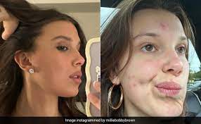 millie bobby brown is normalising acne