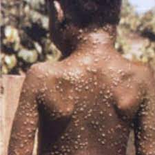 Where are monkeypox cases in UK – and ...