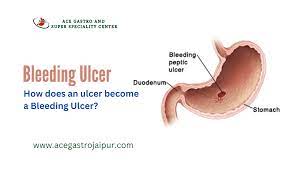 bleeding ulcer