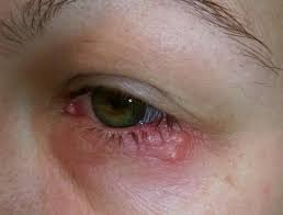 The sores are usually described as an outbreak, with the first outbreak occurring within weeks of exposure to the virus and subsequent outbreaks over a. What Does Herpes Look Like Pictures Treatment And Prevention