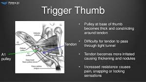 Image result for trigger thumb