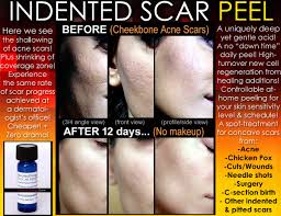 indented acne scar removal l en