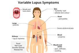 lupus joint muscle cal care and