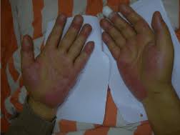Palmar erythema is a rare skin condition where the palms of both hands become reddish. Palmar Erythema In Acute On Chronic Liver Failure