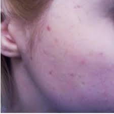 reddit user rid herself of acne scars