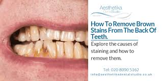 It's critical to know how to remove coffee stains from many different materials if you want to have a happy life as. How To Remove Brown Stains From The Back Of Teeth
