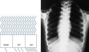 Radiographic Exposure Technique Radiology Key