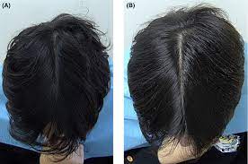 aromatase inhibitor induced hair loss