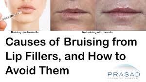 how to avoid bruising after lip fillers
