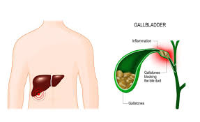 gallstones gi condition charleston gi