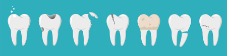 Cavities refer to tooth decay. How Long Does It Take A Cavity To Form Today S Dental Omaha Ne